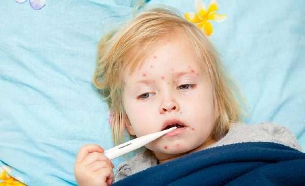 ciri-ciri penyakit campak