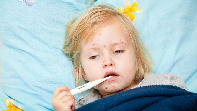 ciri-ciri penyakit campak